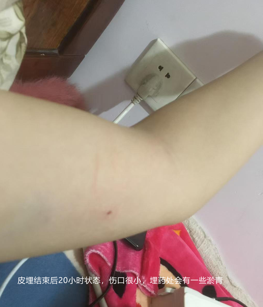皮埋后的皮肤.png